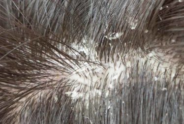 Diferentes tipos de escamas de la caspa