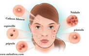 11 diferentes tipos de acné y cómo identificarlos?