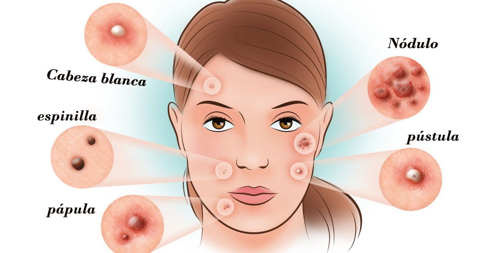 11 diferentes tipos de acné y cómo identificarlos?