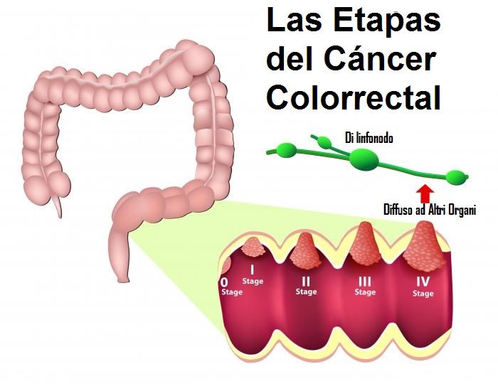 pronóstico del cáncer de colon
