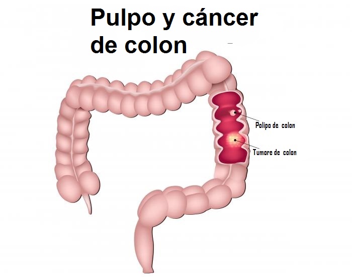 Pulpo y cáncer de colon