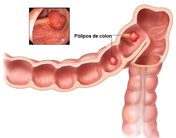 Pólipos de colon