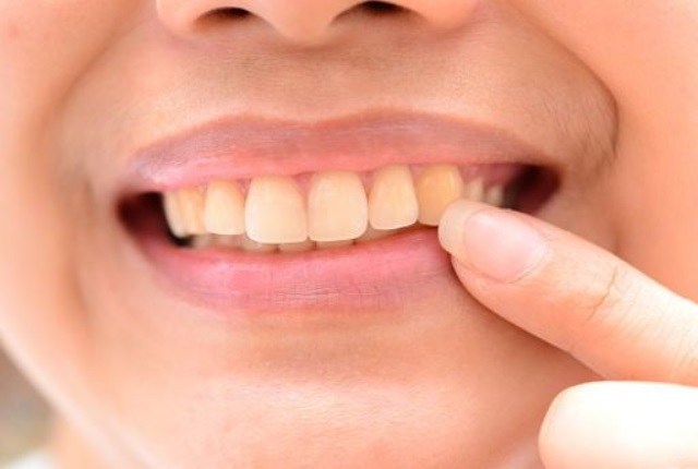 esmalte dental