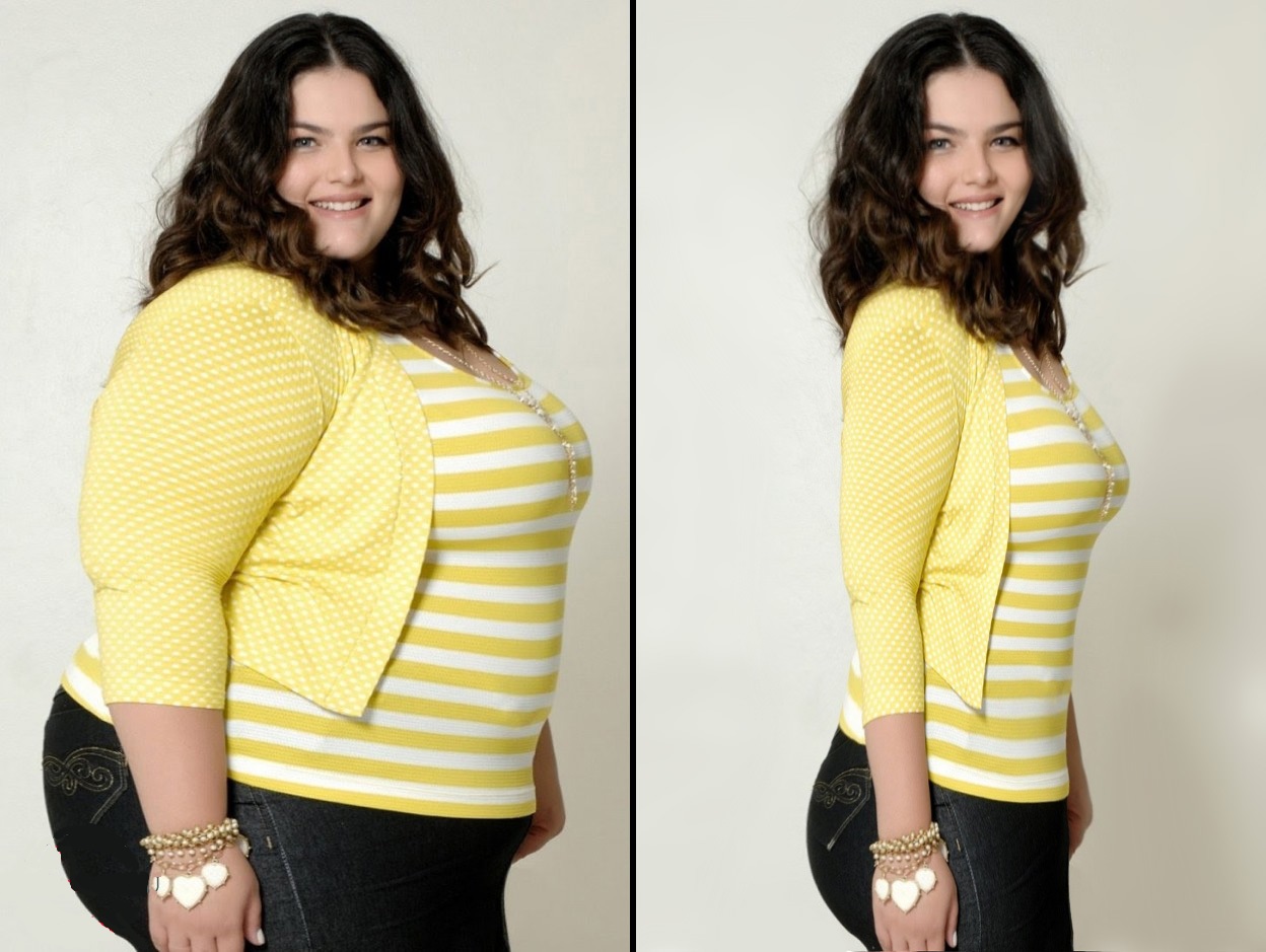 obesidad