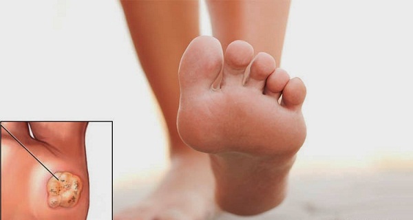 ¿Qué es una verruga plantar?