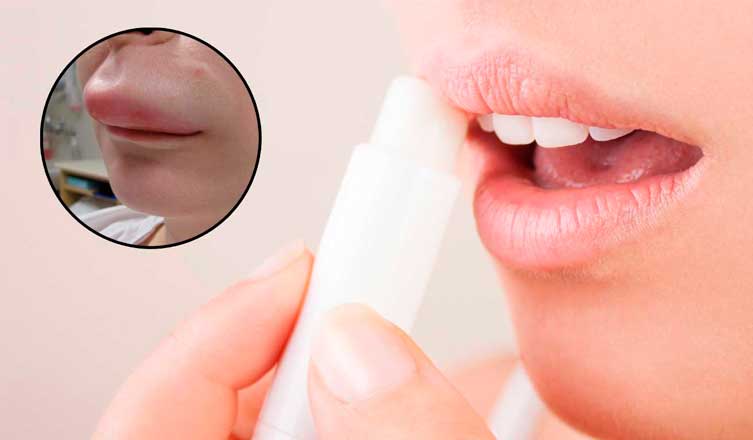 Cómo deshacerse de un labio hinchado rápido
