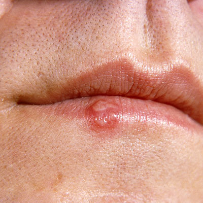 Herpes labial o herpes genital