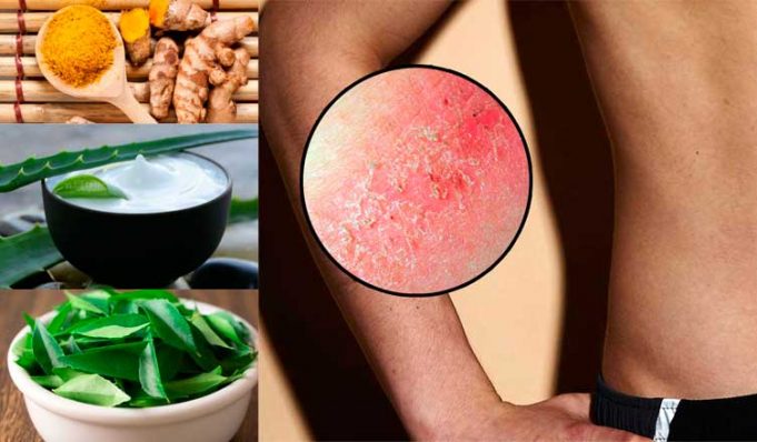 Remedios Caseros Para Las Rozaduras Salud Teu