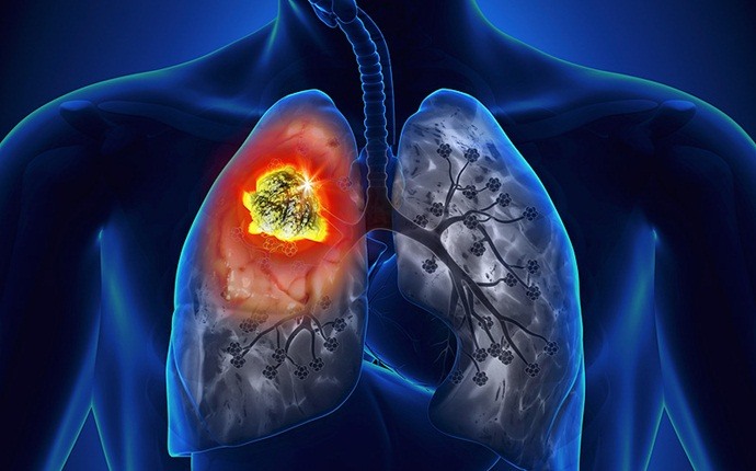 Aumenta la posibilidad de contraer cáncer de pulmón