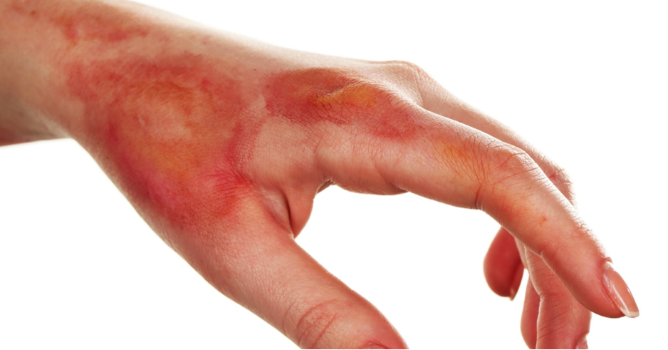 ¿Cómo deshacerse de eczema