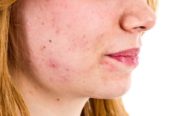 Acné hormonal: uno de los tipos de acné más difíciles de tratar