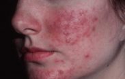 Acné rosácea
