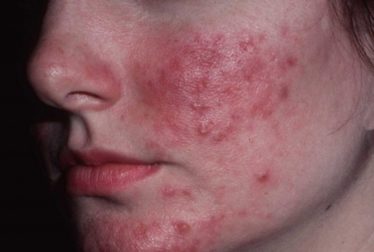 Acné rosácea