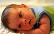 Acné Neonatal o Acné del Bebé Recién Nacido