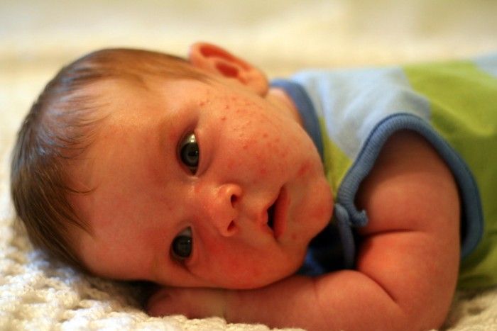 Acné Neonatal o Acné del Bebé Recién Nacido
