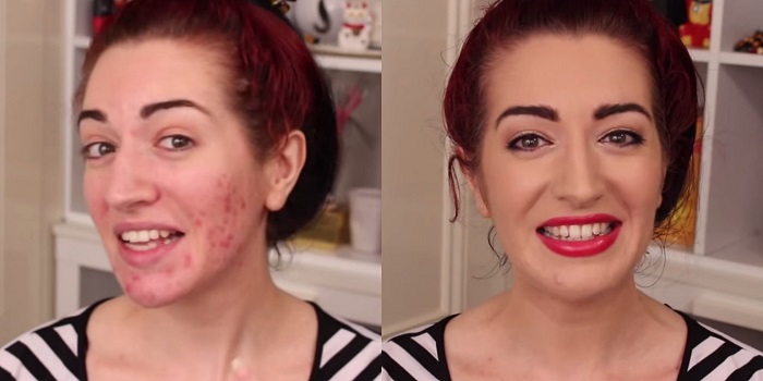Maquillaje y acné - Cómo aplicar maquillaje en la piel propensa al acné