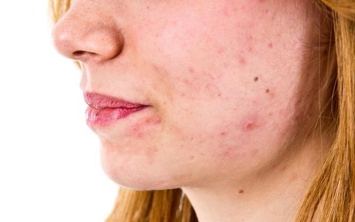 Azucar y acne