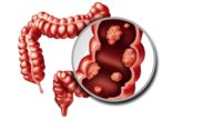 La limpieza de colon realmente cura el acné