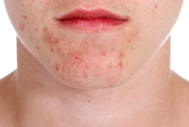 El acné o es eczema