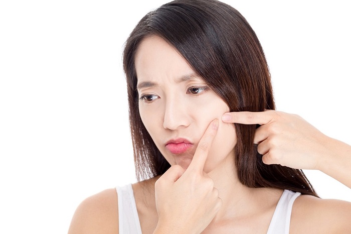 Mitos del acne
